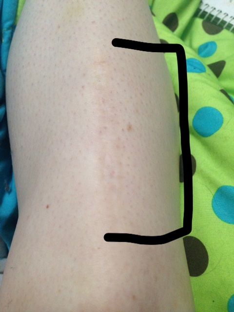 Leg scar 1.JPG