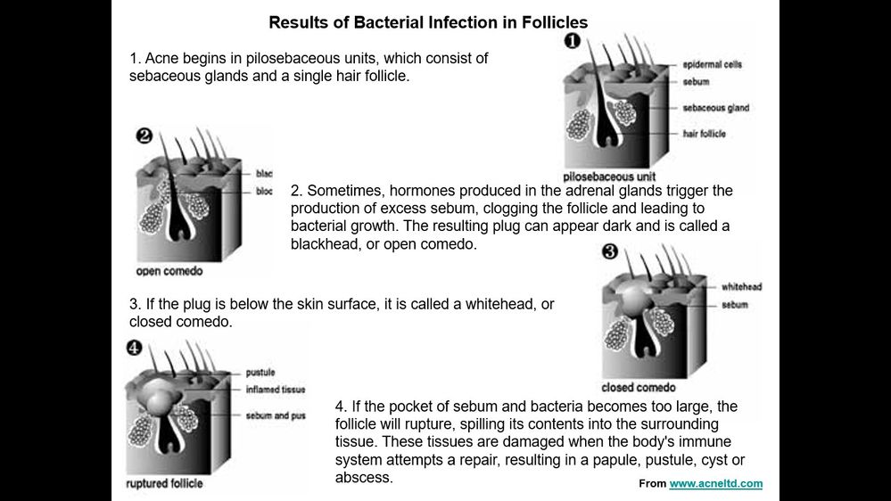 Acne Molecular Biology Picture.jpg