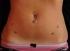 Dermal-Piercing-on-front-of-Abdomen.jpg