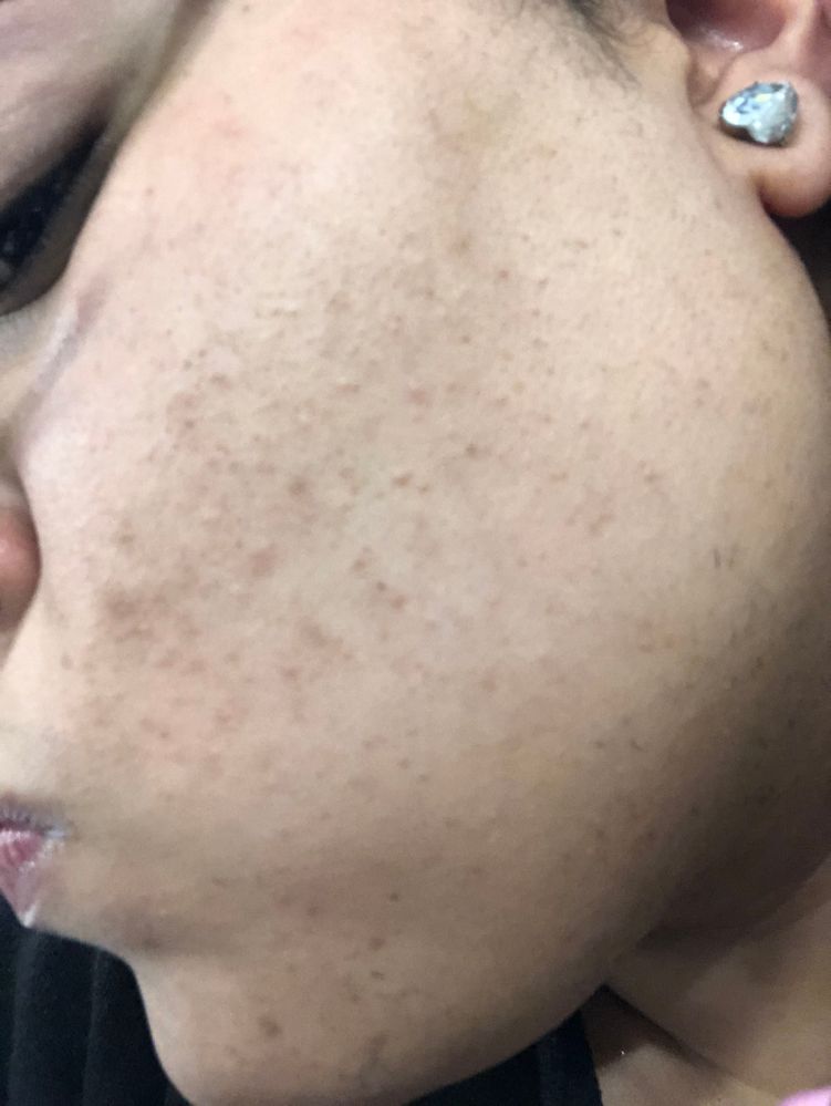 dermaplaning sensitive skin
