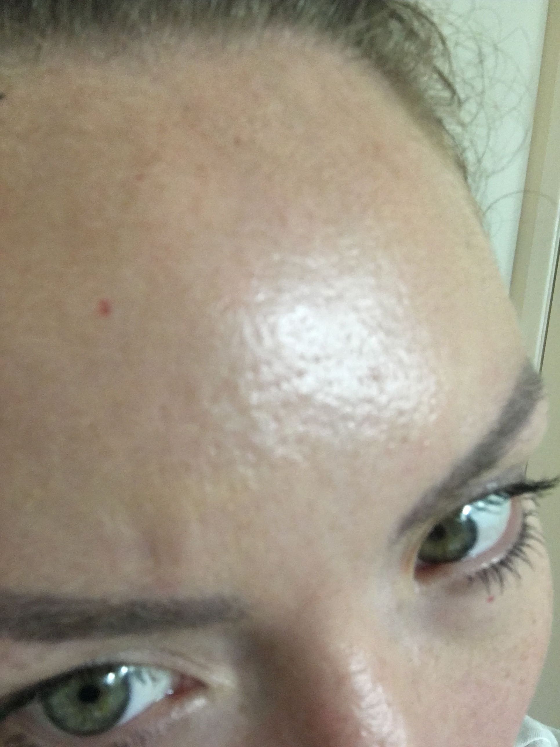 Small holes on my face! - Beauty Insider Community