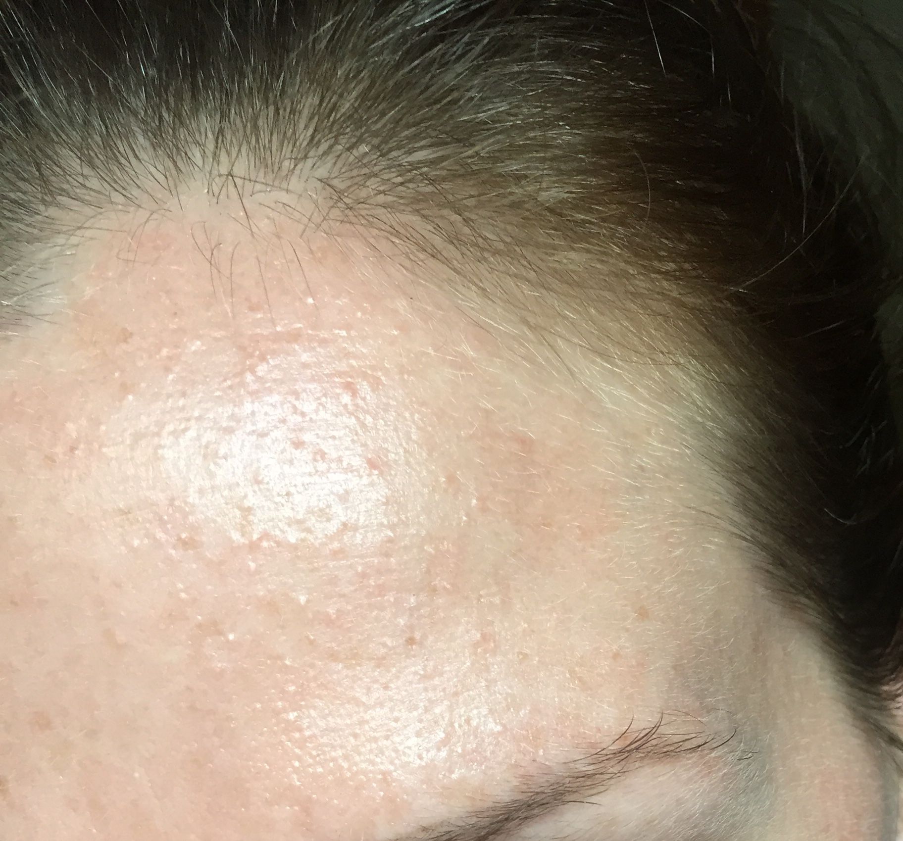 Small rash like bumps all over face - Beauty Insider Community