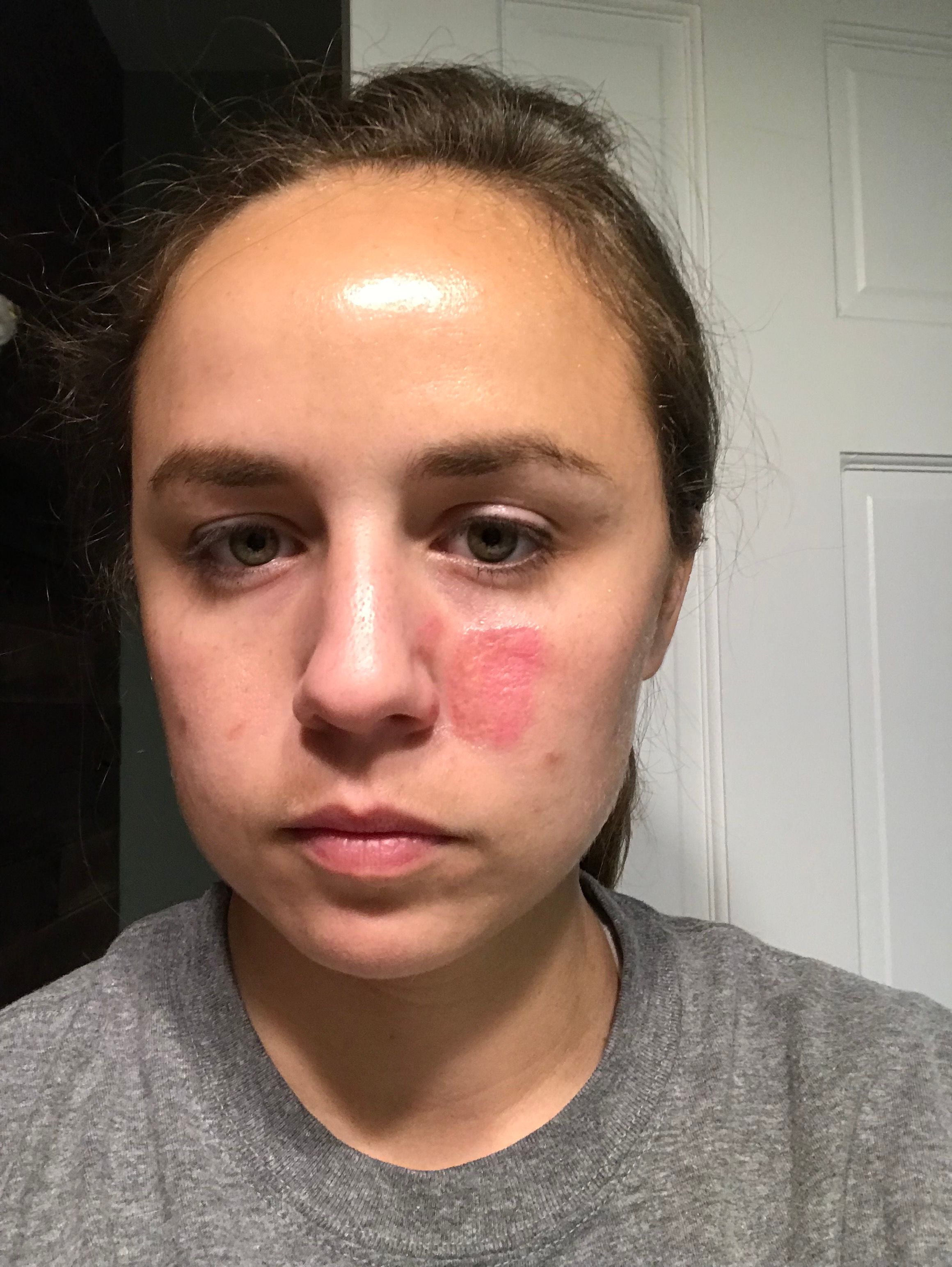 Facial Burn Scar - Beauty Insider Community