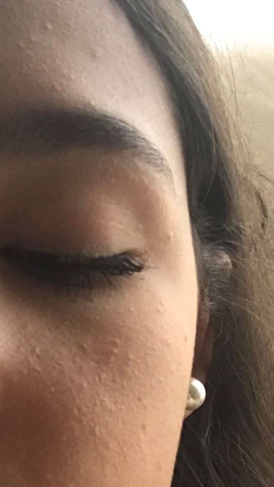 Skin Bumps Beauty Insider Community