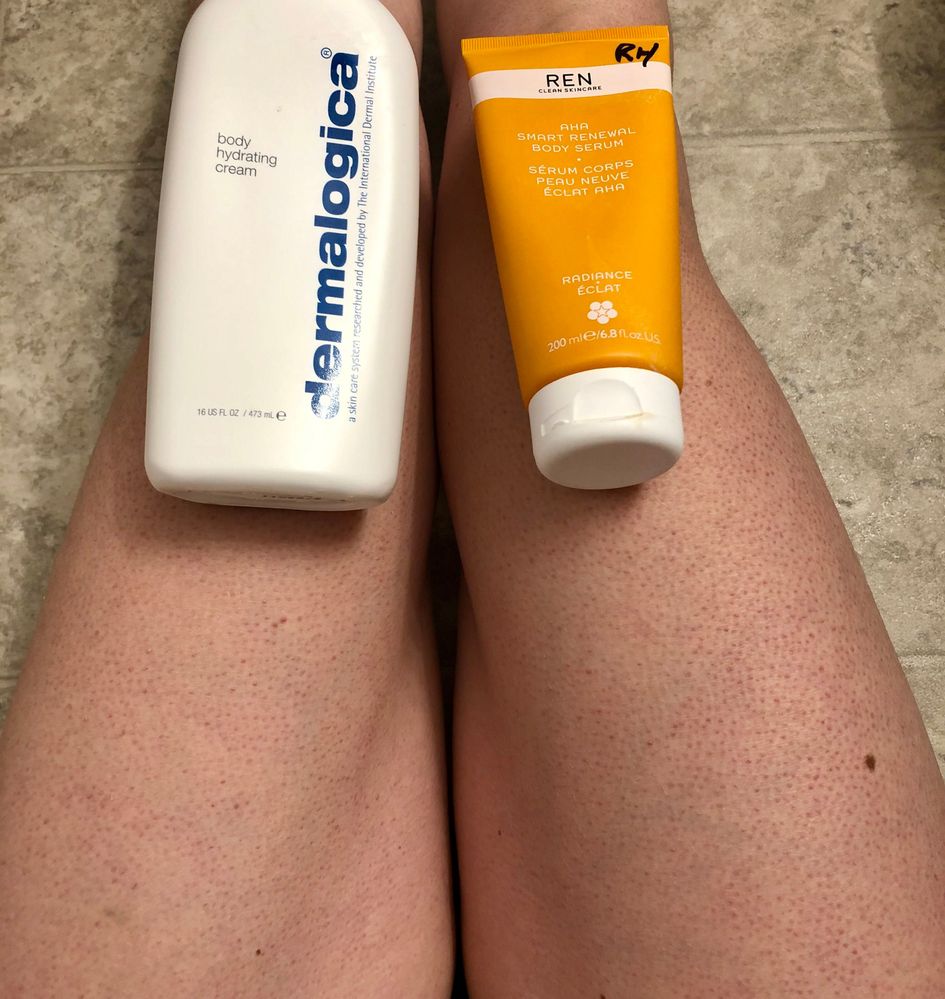 Keratosis pilaris Finally a product th... Beauty Insider Community