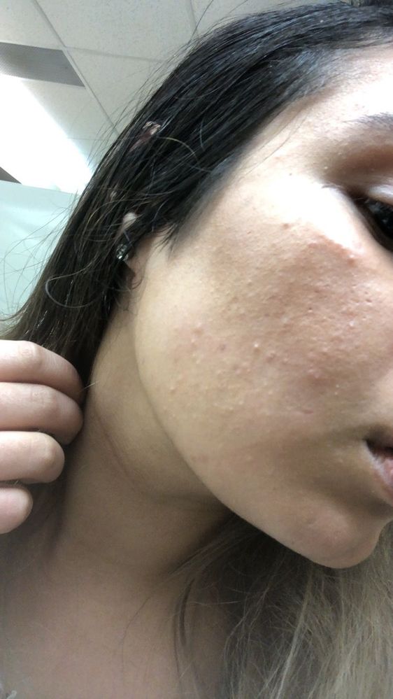 cetaphil moisturizer fungal acne