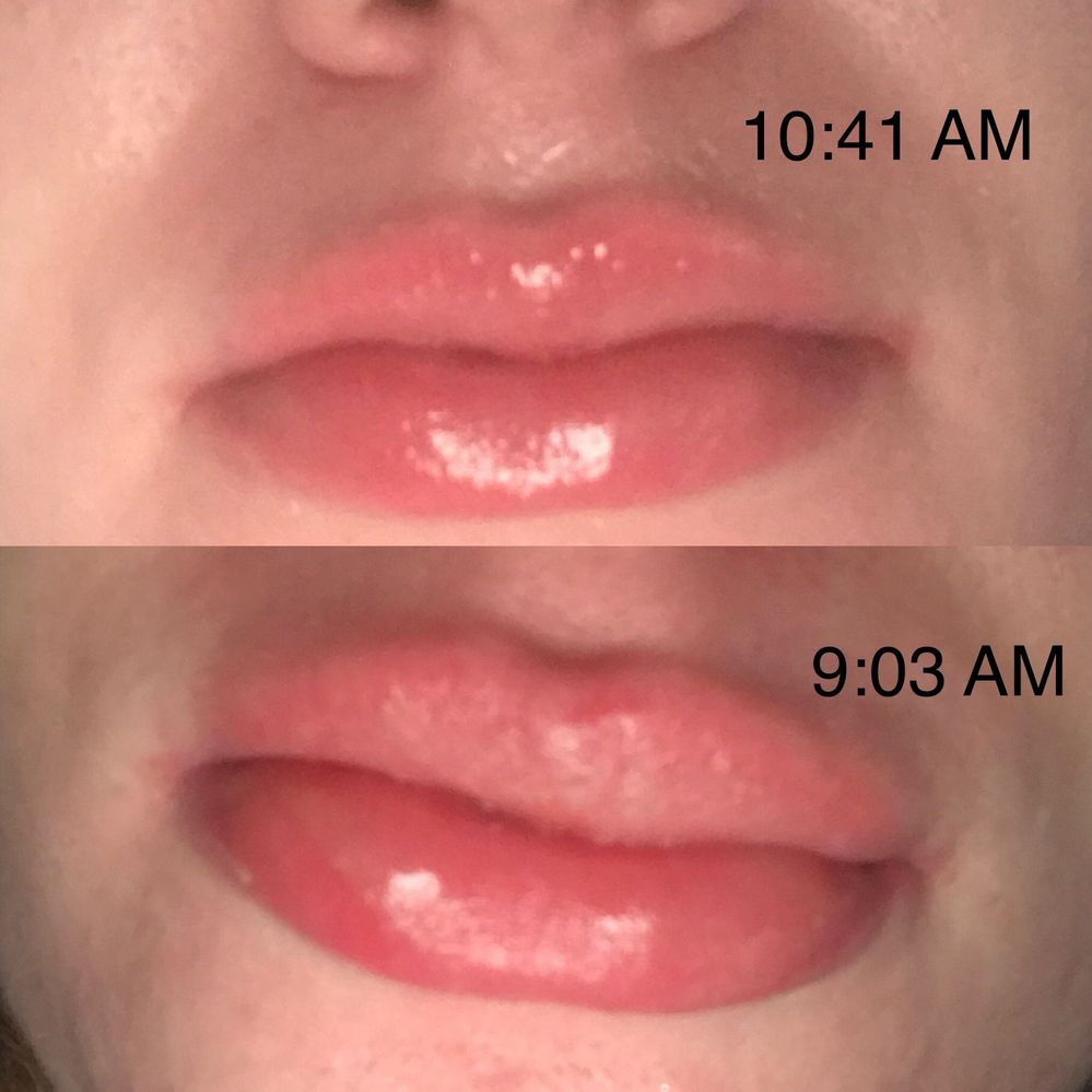 Bottom photo about an hour after waking up.   Top photo after a dose of Benadryl and ice