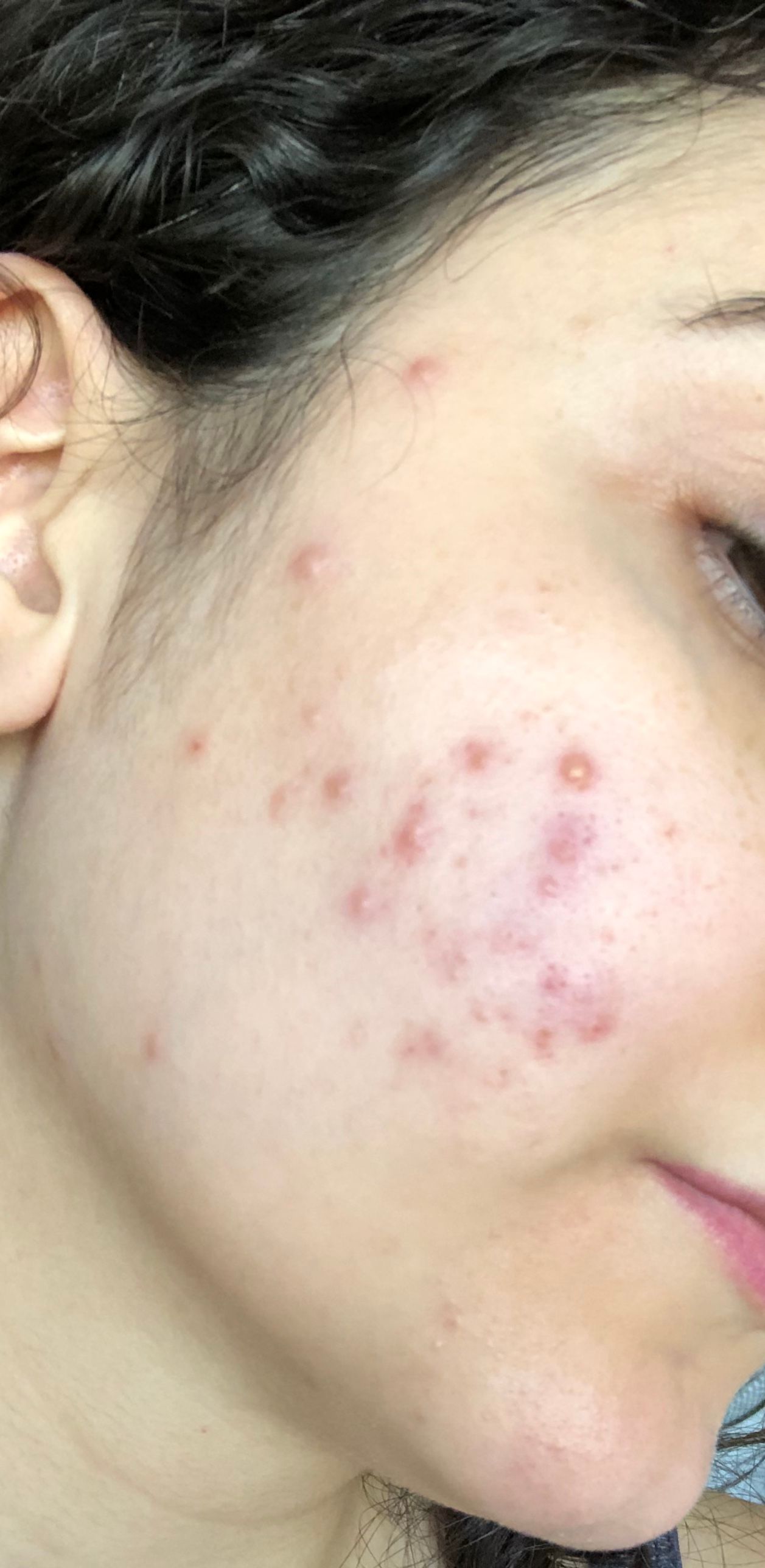 Red bumps on cheeks - Beauty Insider Community