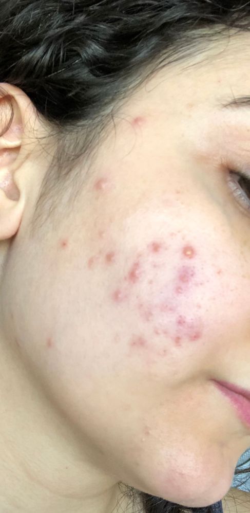 Re: Red bumps on cheeks - Beauty Insider Community
