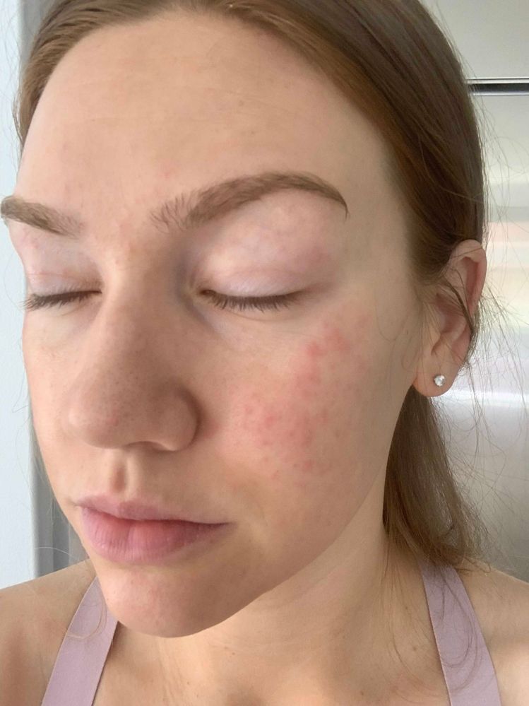 Re: SOS! Please help a mama out! Allergi... - Beauty Insider Community