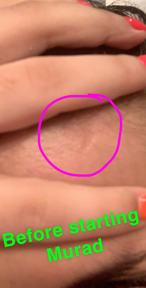 Little scar in my hairline