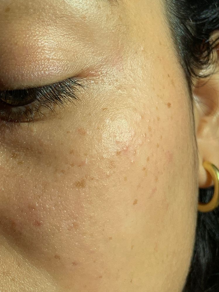 Skin Colored Small Bumps On Face From Su Beauty Insider Community