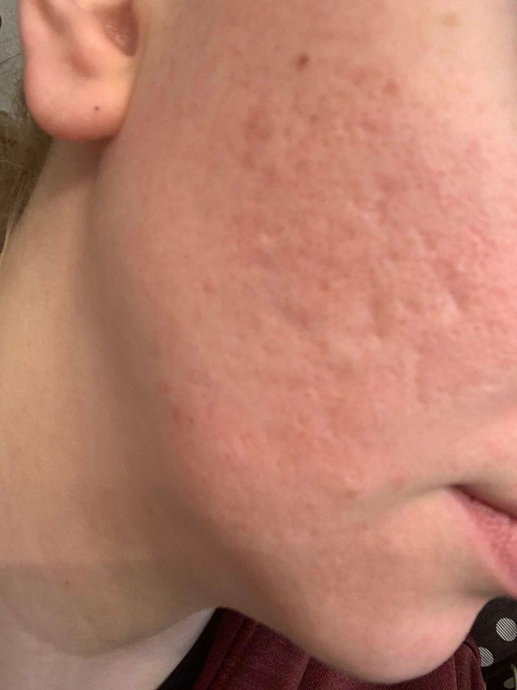 deep acne scars