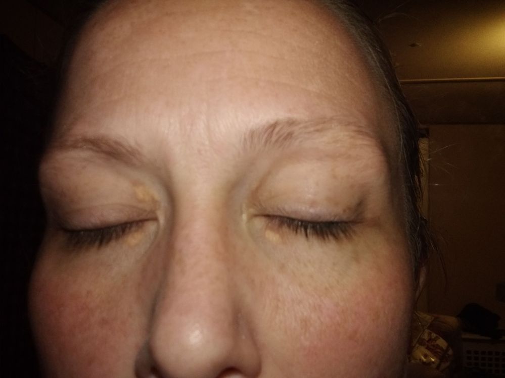 This is what mine spots look like. They're not raised or bumpy and nothing I try seems to cover it up. And it looks like the pictures when I googled Xanthelasma