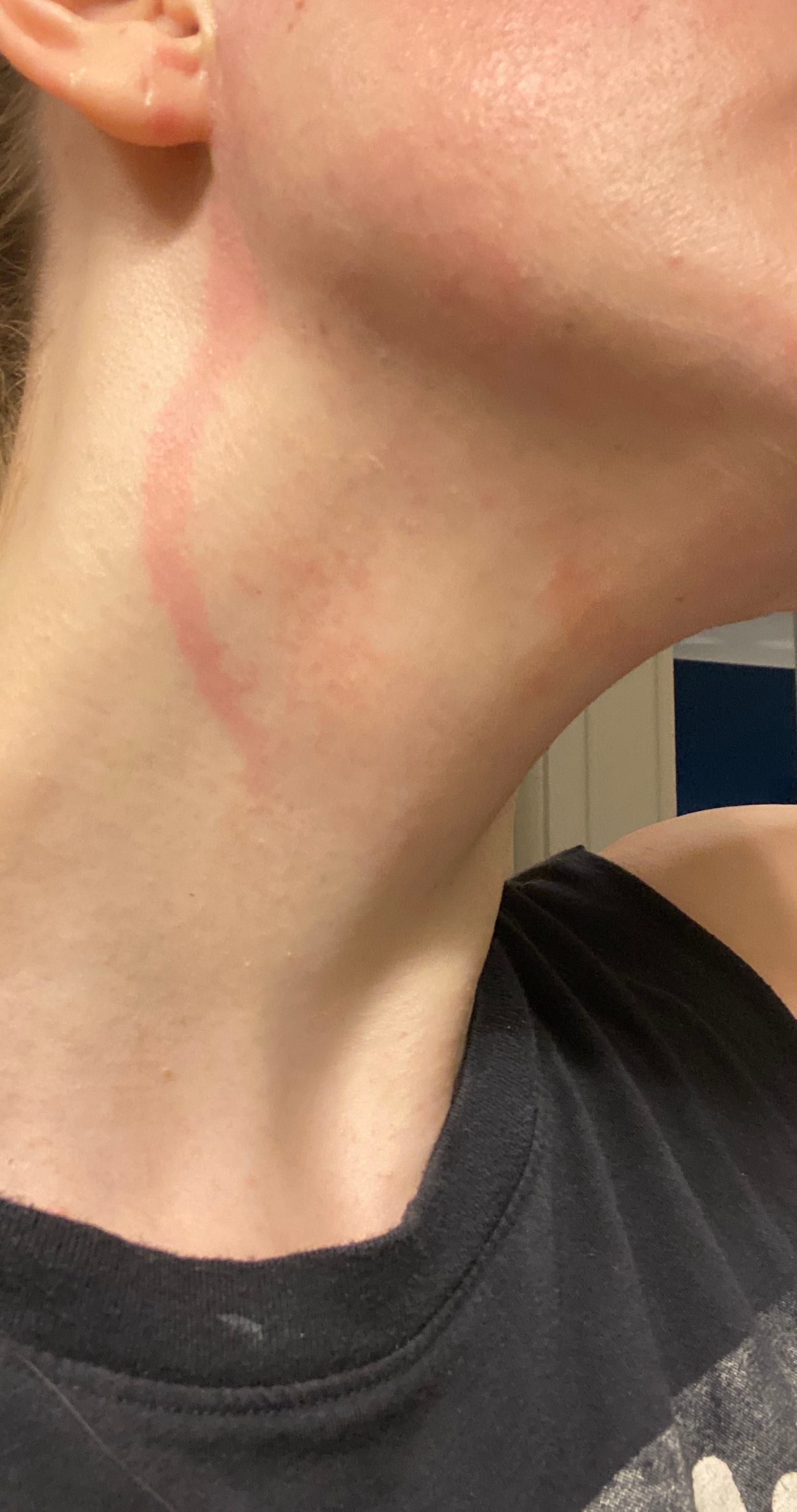 Drunk Elephant allergic reaction!? Beauty Insider Community