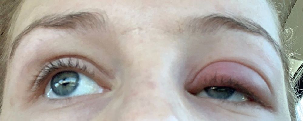 Allergic Reaction to Huda New Nudes - Beauty Insider Community