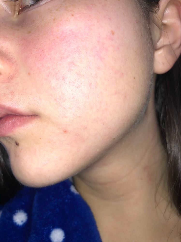 Tiny rash like bumps on cheeks?? - Beauty Insider Community