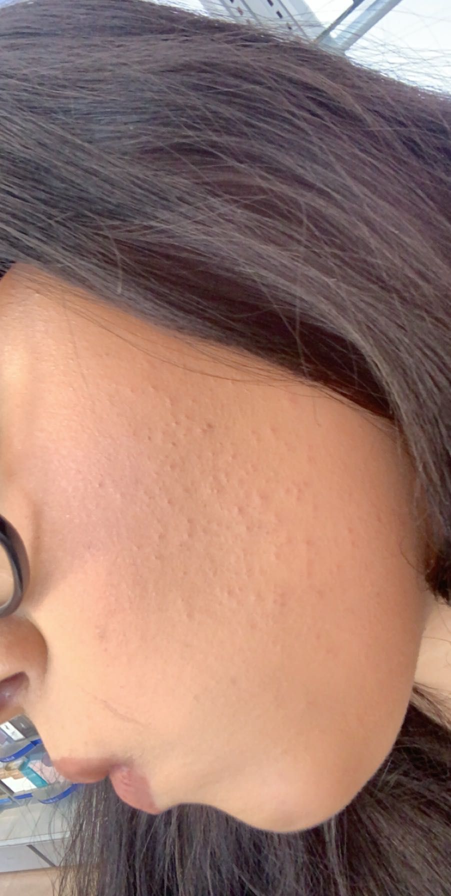 Is My Skin Purging Or Having A Bad React Beauty Insider Community