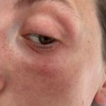 Contact Eye Dermatitis