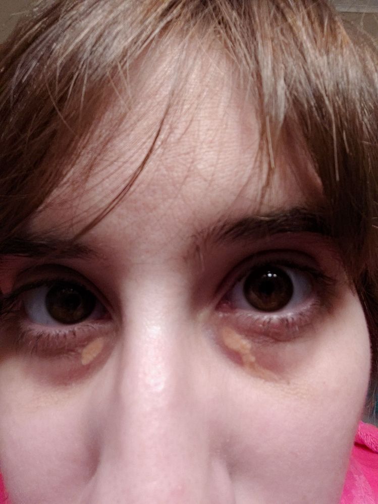 xanthelasma and dark circles