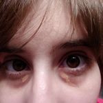 xanthelasma and dark circles