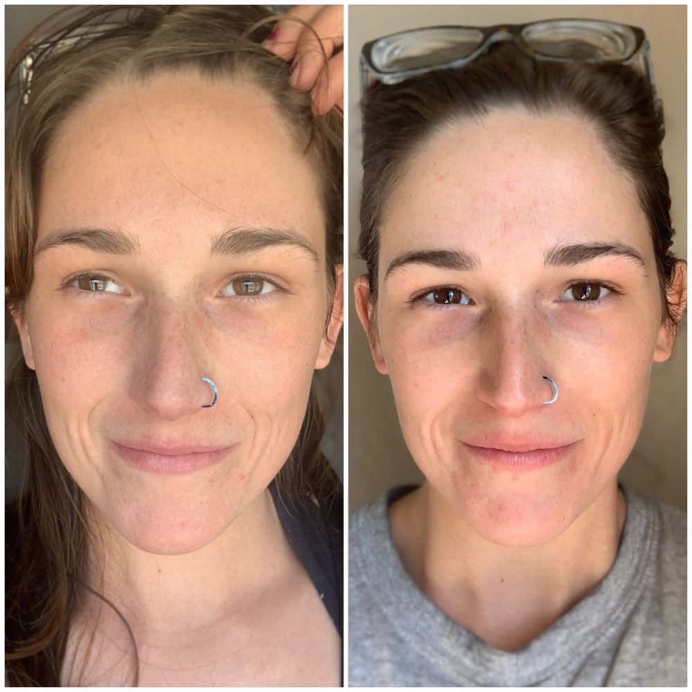 Nothing on my face. To the left was before treatments. To the right is three treatments later. Drunk elephant retinol cream. #sephoraskinwins #beautyinsidercommunity #sephorapartner @drunkelephant