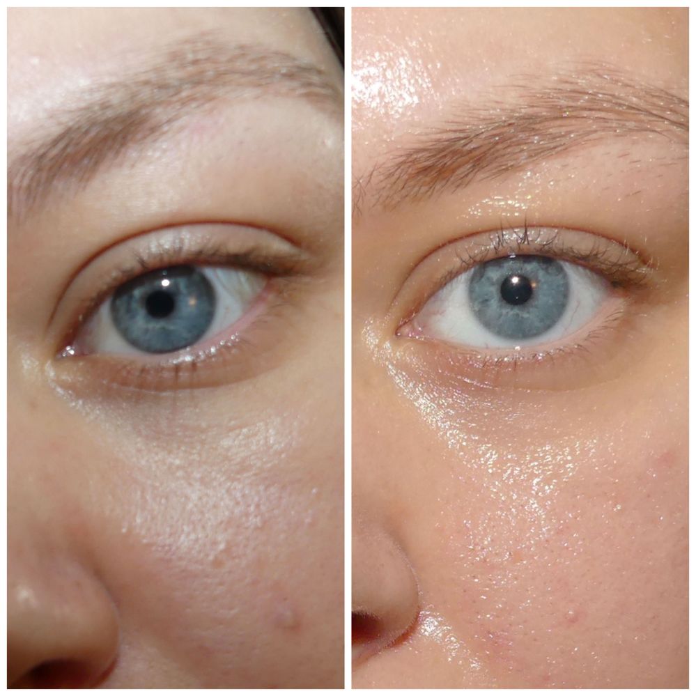 retinol under eyes before and after