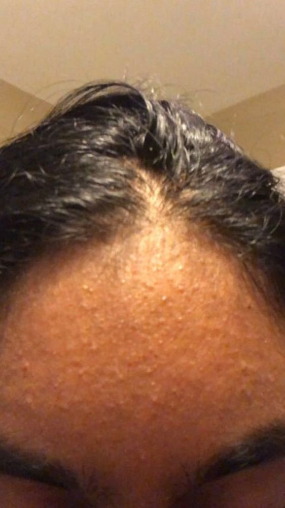 skincare for tiny bumps