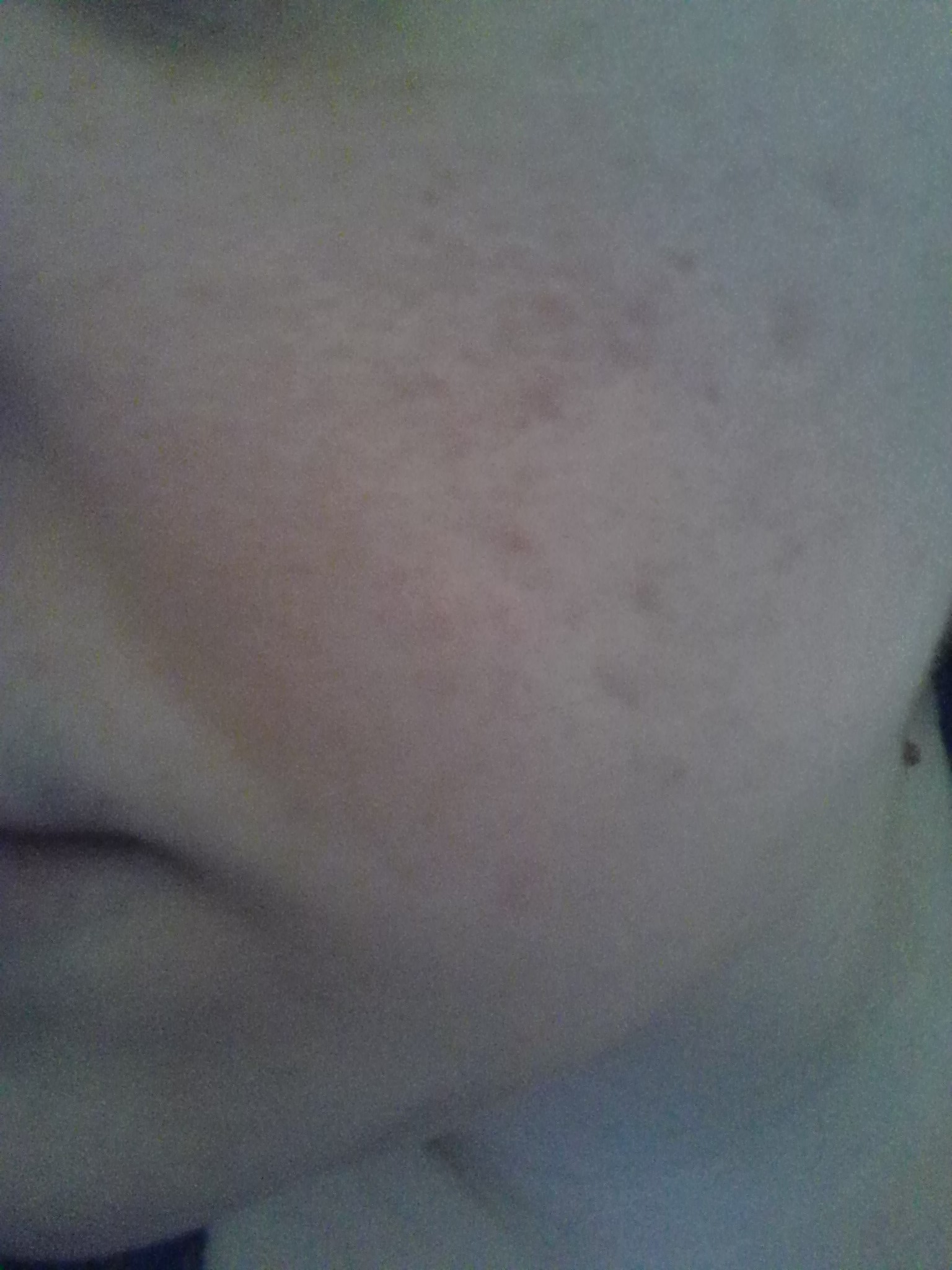 Acne Scarring/Redness/Pock Mark Help Beauty Insider Community