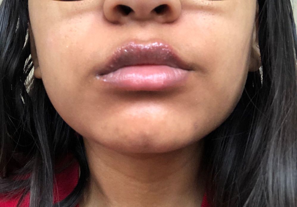 Bite Beauty - Allergic Reactions? - Beauty Insider Community