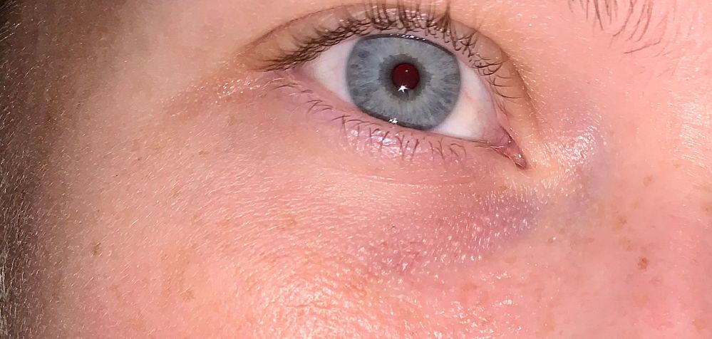 little tiny raised pores or bumps in crease of the eye-- what is it and how do i make it go away?! :(