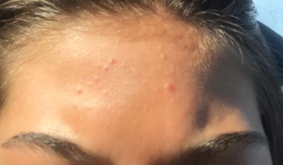 Fungal Acne Or Closed Comedones Beauty Insider Community