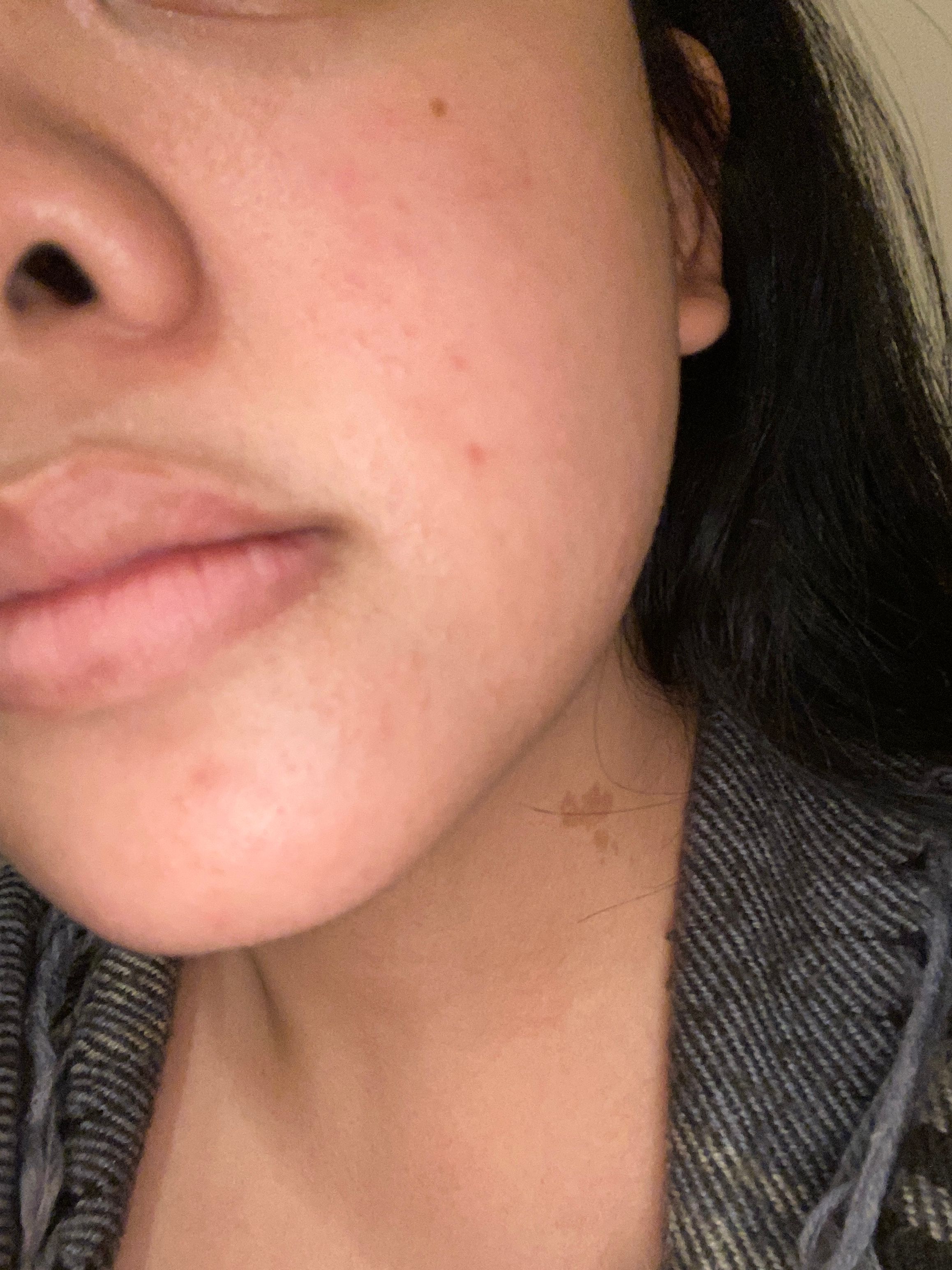 HELP! sudden itchy textured face - Beauty Insider Community