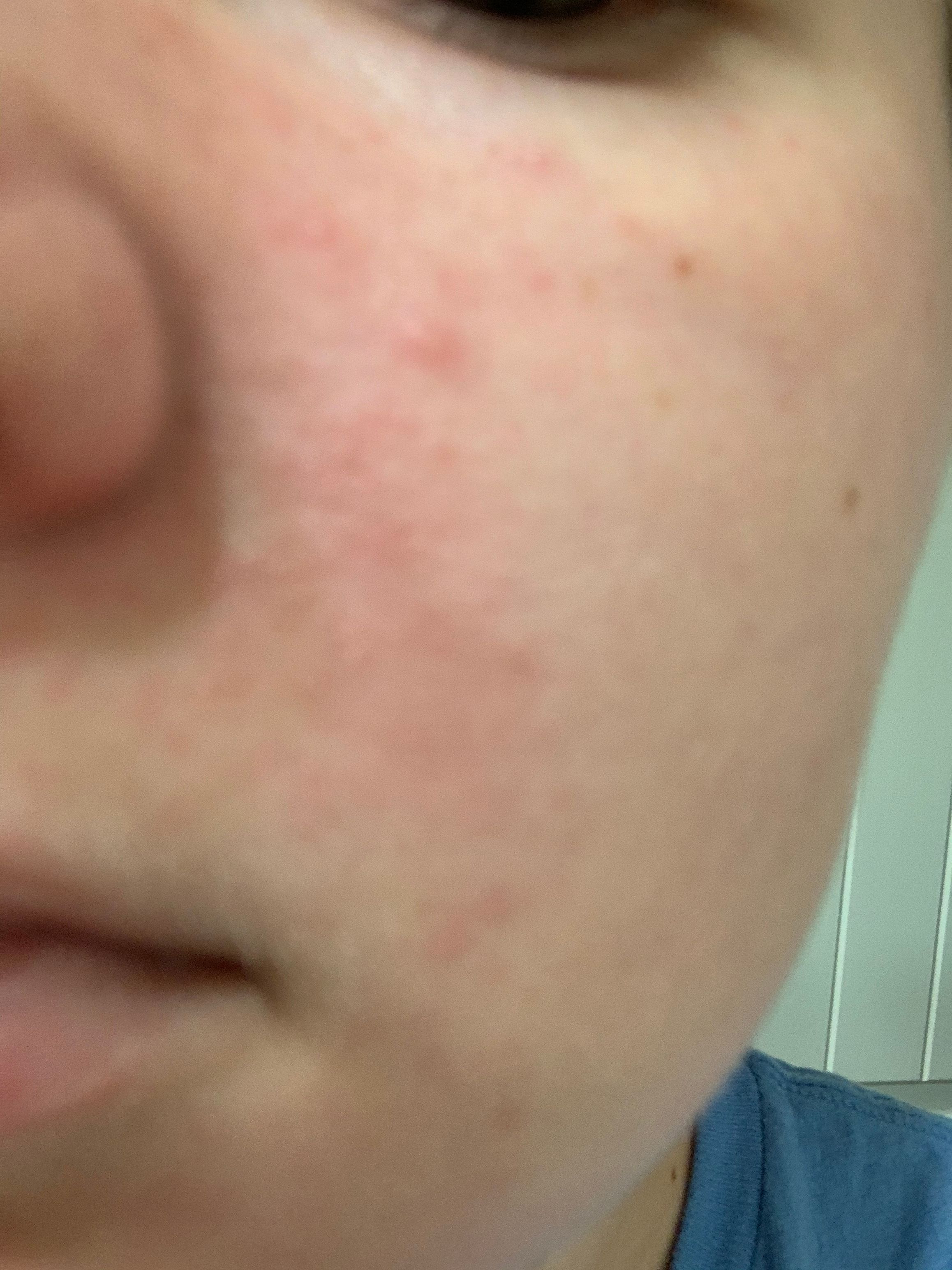 Help perioral dermatitis Beauty Insider Community