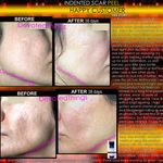 Before and After pics Rolling Indented Acne Scar Removal At Home Peel Devotedthings copy.jpg