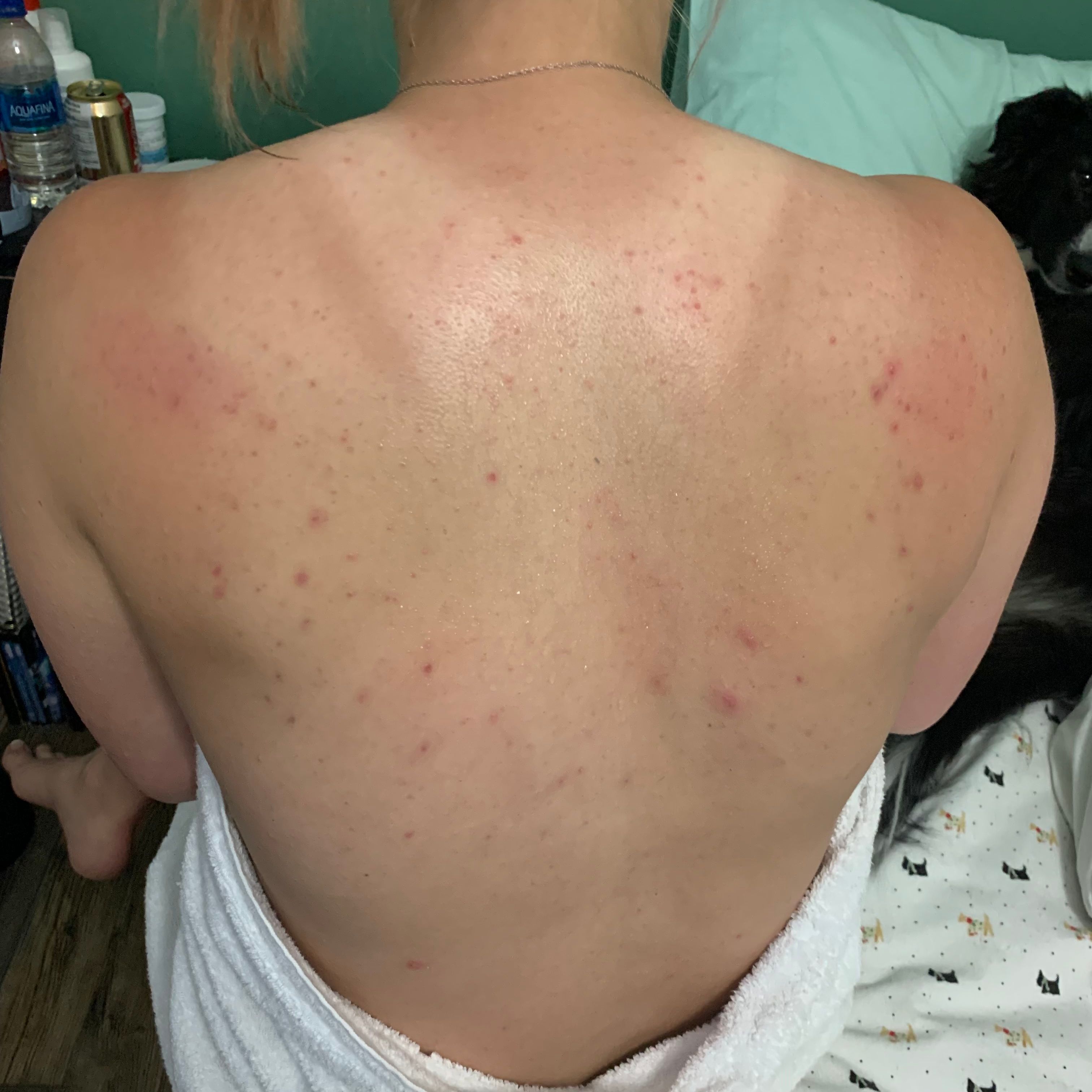 What to Know About Using Tattoos to Cover Scars | Removery, image size:3024x3024