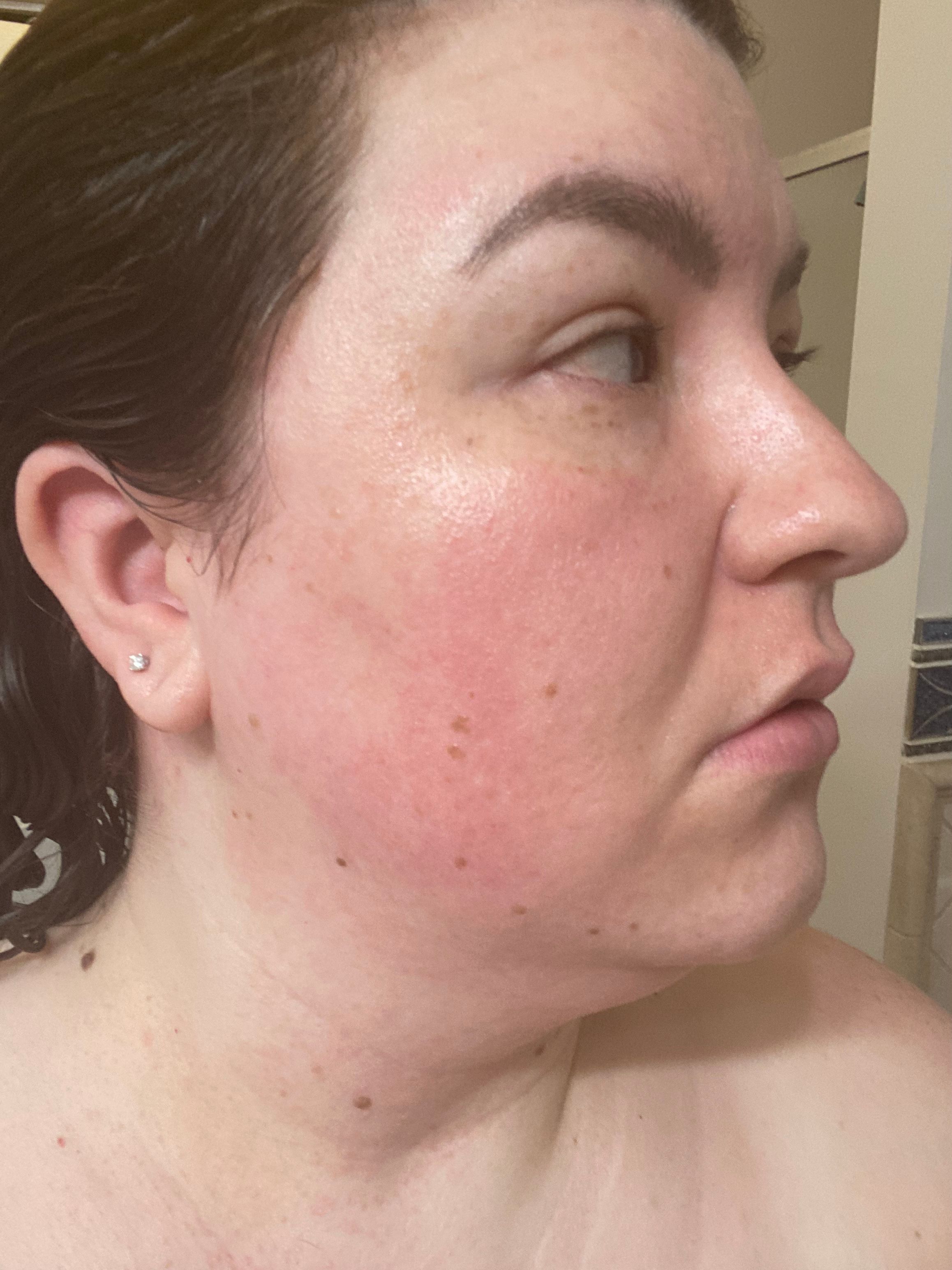 Olaplex 0 - allergic reaction? - Beauty Insider Community