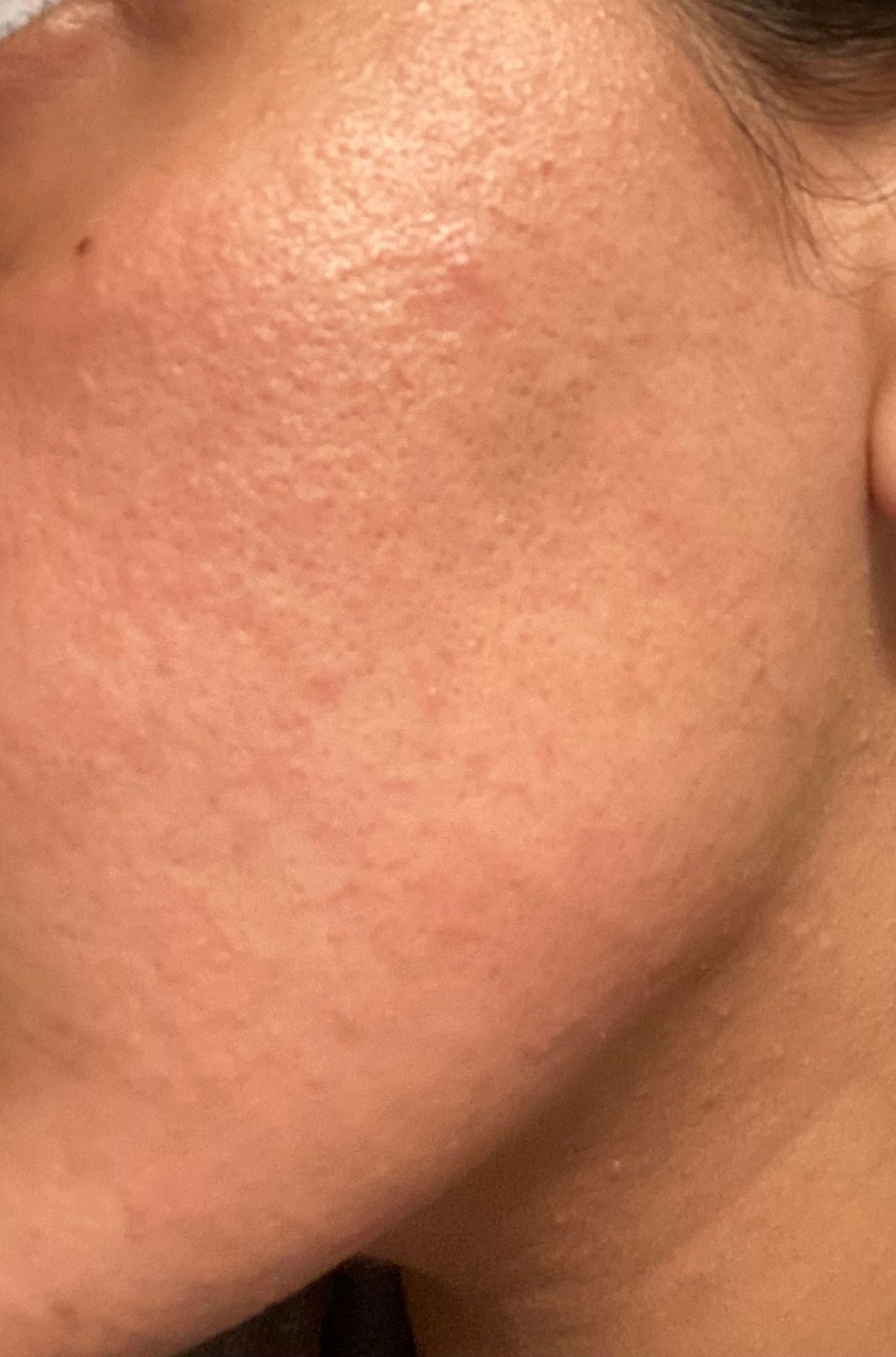 small rash like bumps on face - Beauty Insider Community