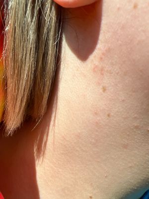 Red spots on face - Beauty Insider Community