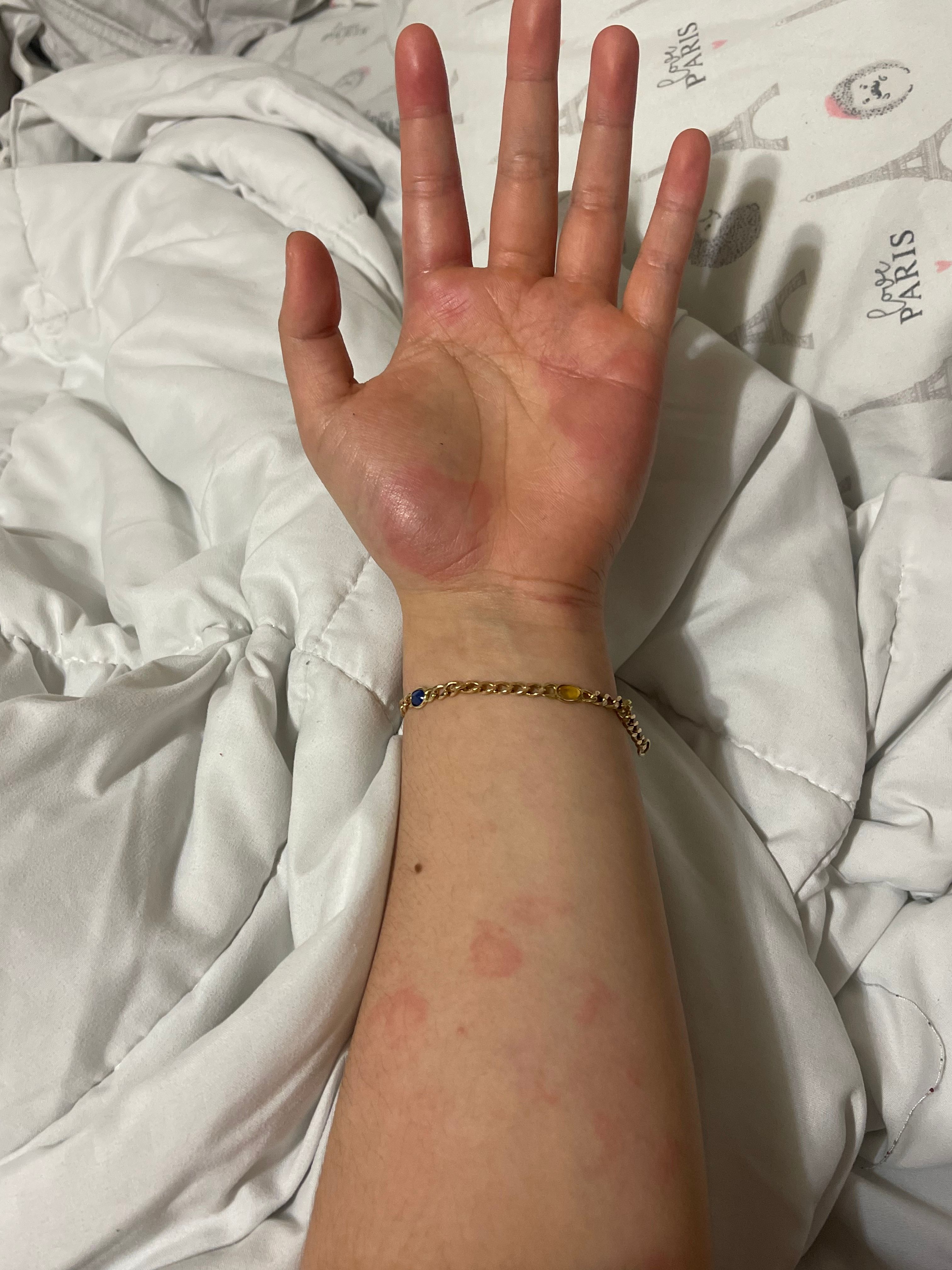 Olaplex severe allergic reaction - Beauty Insider Community