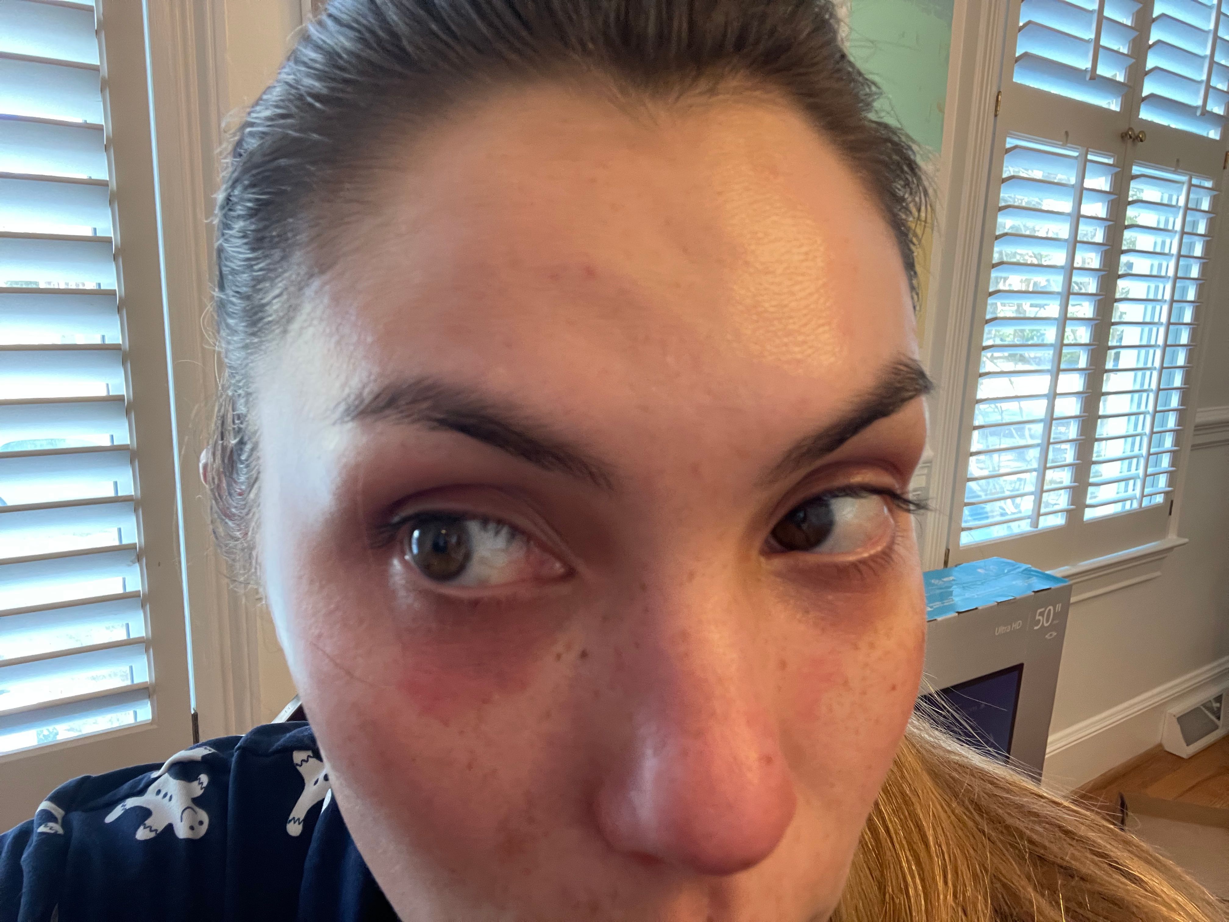 Allergic reaction to NARS concealer Beauty Insider Community