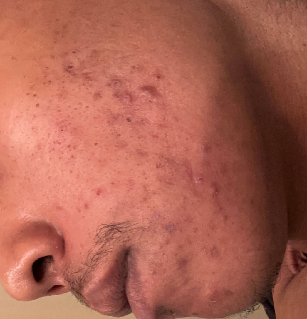 Bumps under skin and red bumps, Please h... Beauty Insider Community
