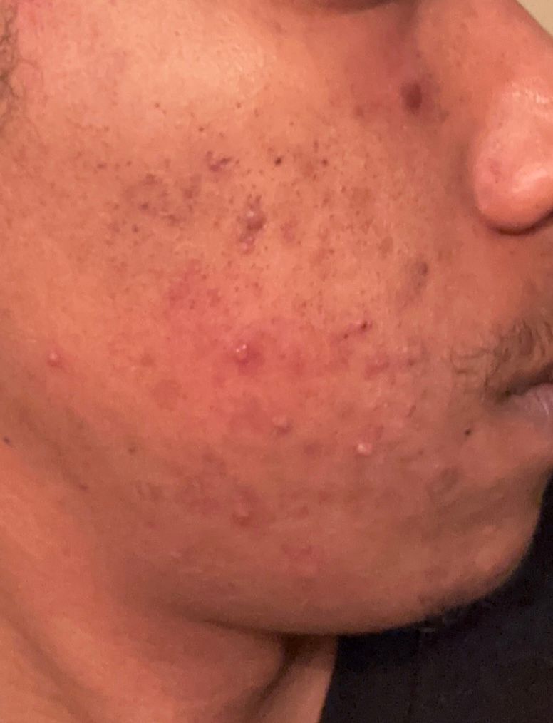 Bumps under skin and red bumps, Please h... Beauty Insider Community