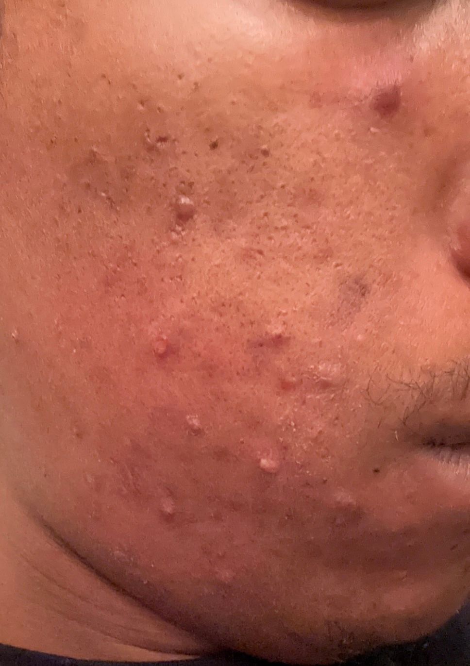 Bumps under skin and red bumps, Please h... Beauty Insider Community