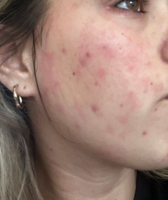 allergic reaction? or damaged skin barri... - Beauty Insider Community