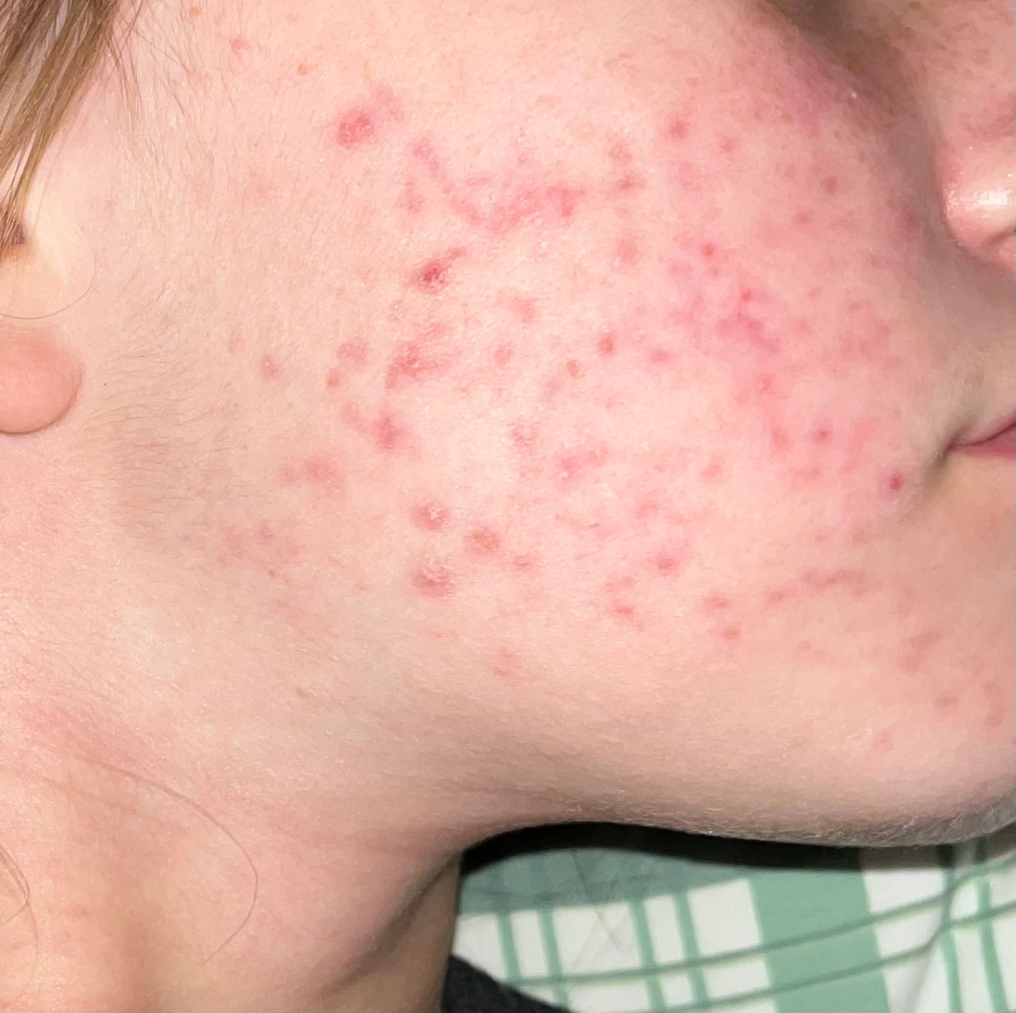 Folliculitis scarring and dark spots - Beauty Insider Community