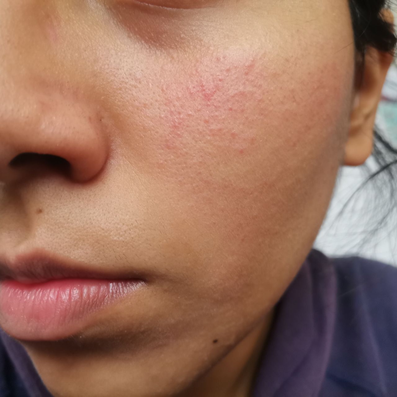 HI. I NEED HELP W THIS. ID IF ITS FUNGAL ACNE, CLOSED COMEDOONES OR ROSACEA  !!! derms not helping