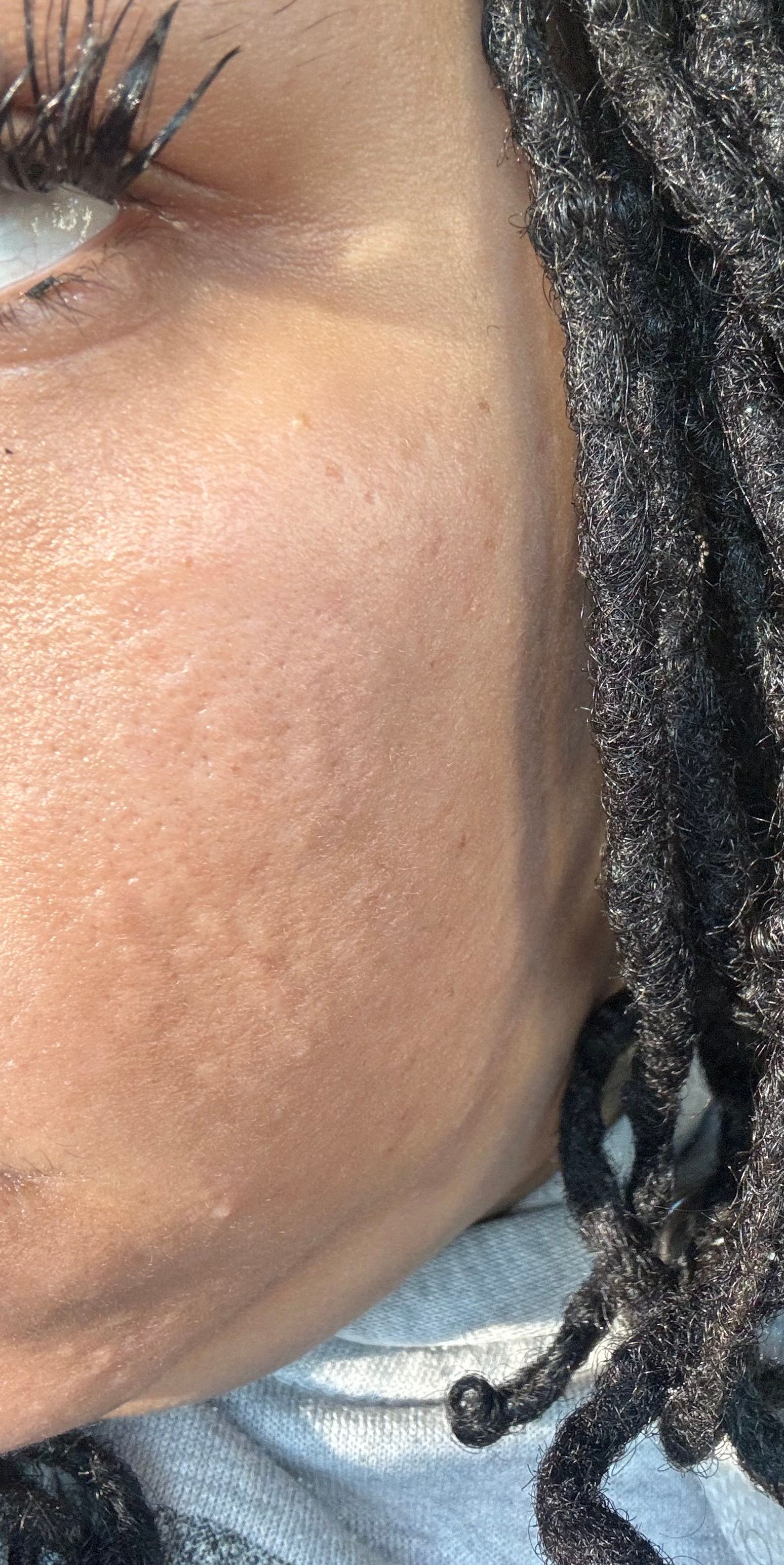 Help flesh colored bumps!! - Beauty Insider Community