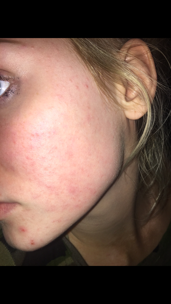 Small bumps all over my face! - Beauty Insider Community