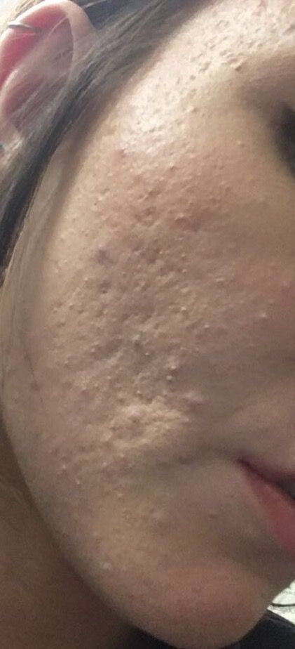 Tiny bumps all over face - HELP:( - Beauty Insider Community